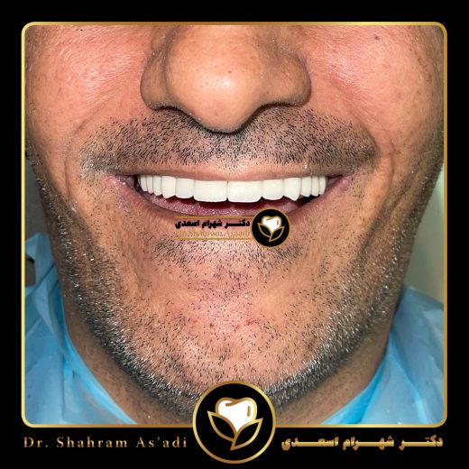تاثیر داروها در موفقیت کاشت ایمپلنت
