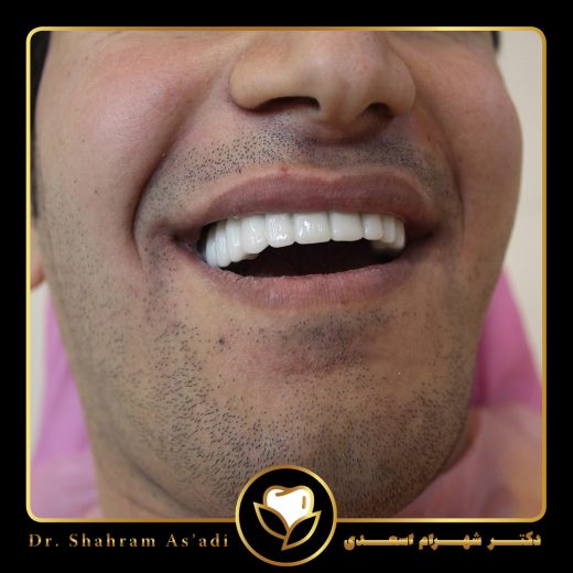 جراحی با لیزر برای بیماران دیابتی