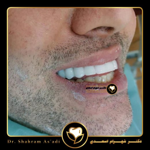 ایمپلنت برای افراد دیابتی