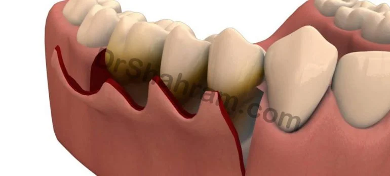 جراحی لثه برای روکش دندان؛ افزایش طول تاج دندان با لیزر
