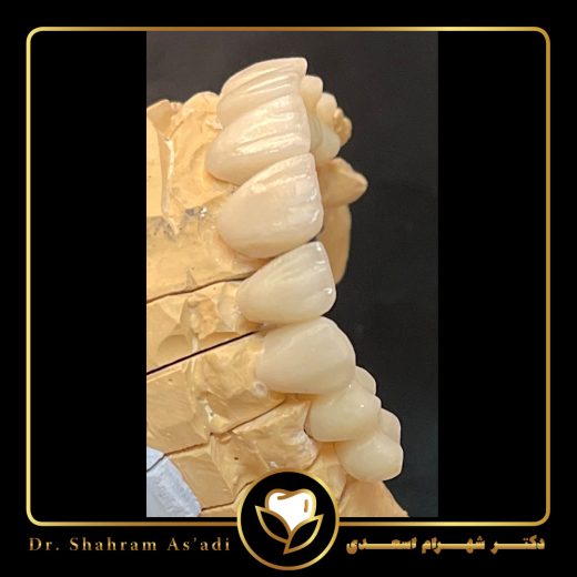 لمینت کامپوزیتی و همه چیز درباره ساخت، مزایا، ماندگاری و هزینه این روش