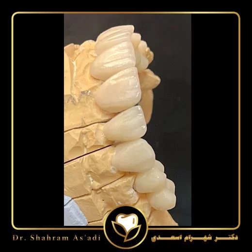 لمینت کامپوزیتی و همه چیز درباره ساخت، مزایا، ماندگاری و هزینه این روش