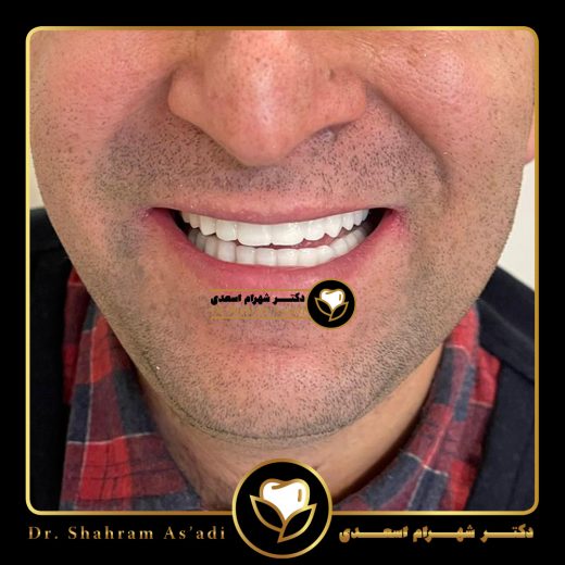 اصلاح طرح لبخند