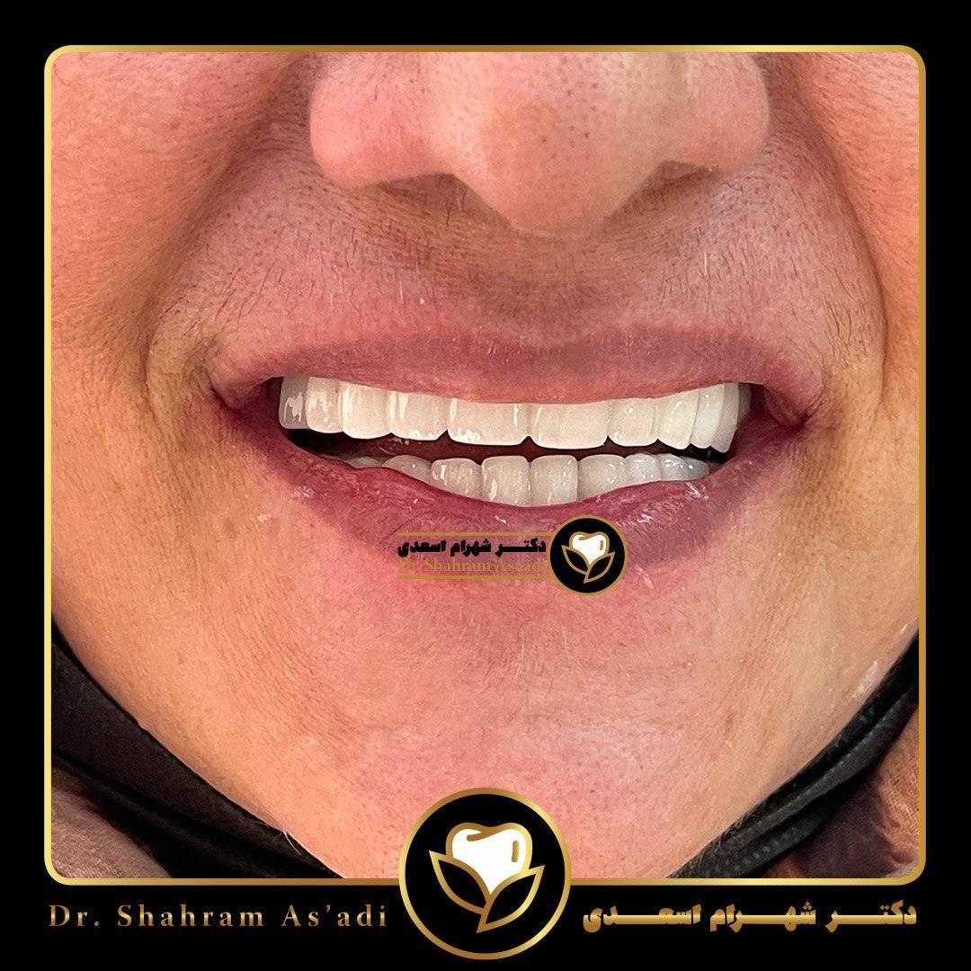 نقش لثه در اصلاح طرح لبخند