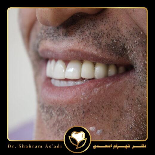 ایمپلنت دیجیتال چیست و چه تفاوتی با روش سنتی دارد؟