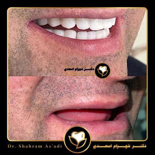 کاشت ایمپلنت بدون جراحی