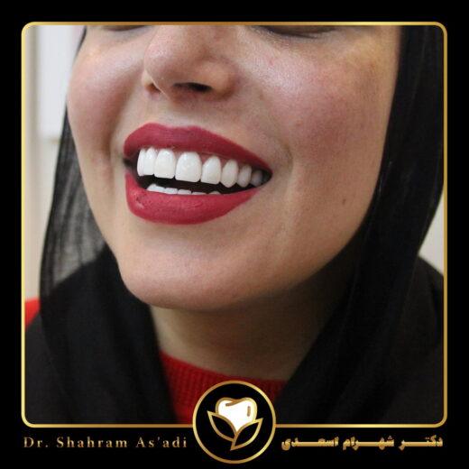 دندانپزشکی با لیزر