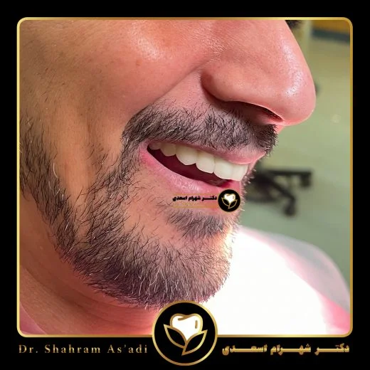 طراحی لبخند