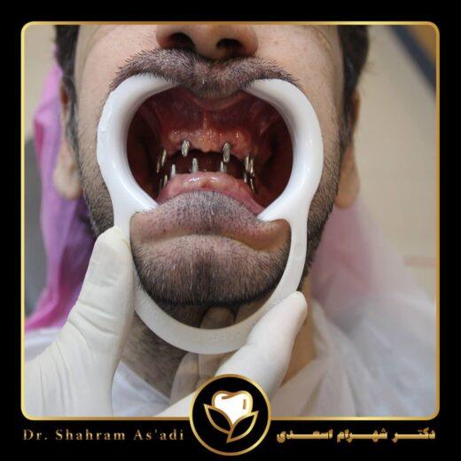 جراحی لثه برای کاشت ایمپلنت دندان