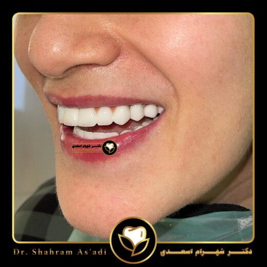 ایمپلنت پانچ | کاشت دندان بدون جراحی و بخیه