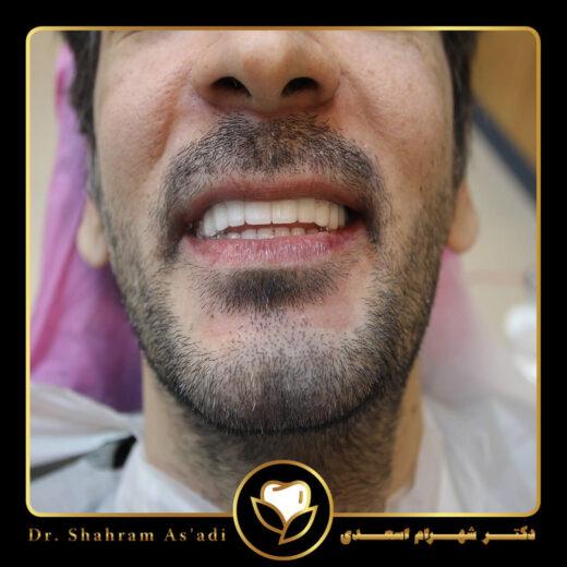 جراحی لثه برای ایمپلنت