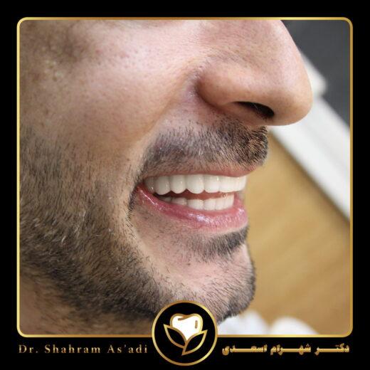 جراحی لثه برای ایمپلنت