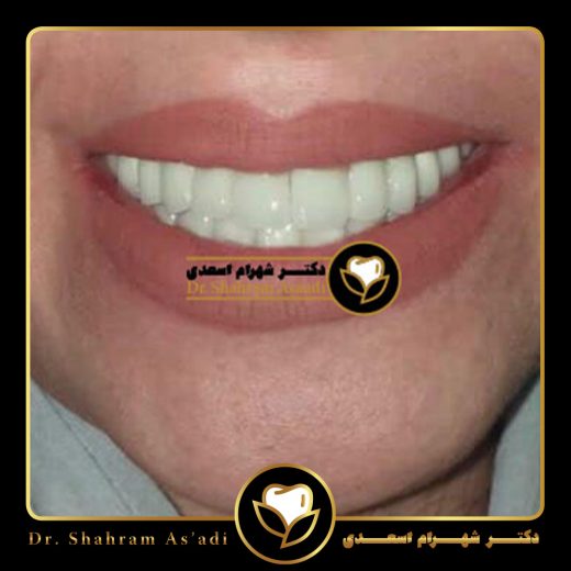پیوند لثه چیست؟ | هزینه پیوند لثه، درد، مراحل جراحی و عکس قبل و بعد