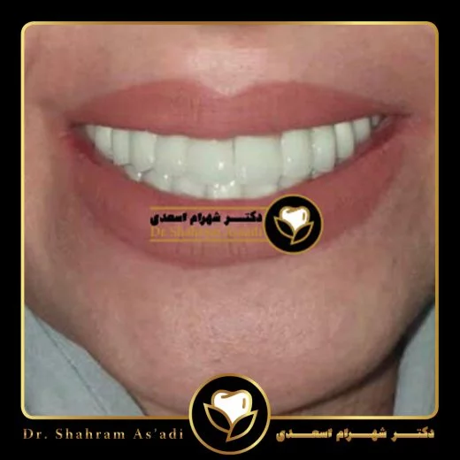 پیوند لثه چیست؟ | هزینه پیوند لثه، درد، مراحل جراحی و عکس قبل و بعد