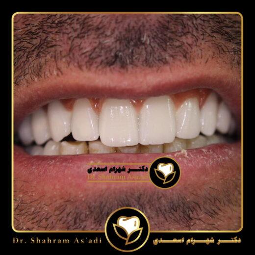 مراقبت بعد جراحی لثه و ایمپلنت