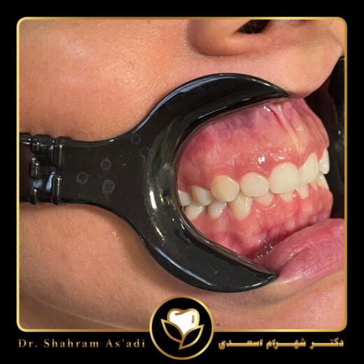 جراحی لبخند لثه ای