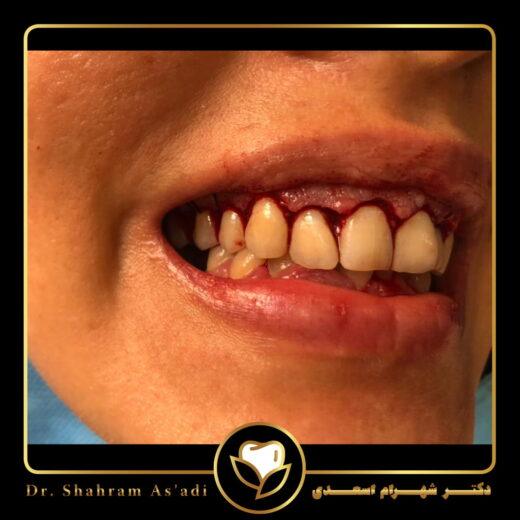 لیفت لثه چیست؟ درمان لبخند لثه‌ای با لیزر و جراحی