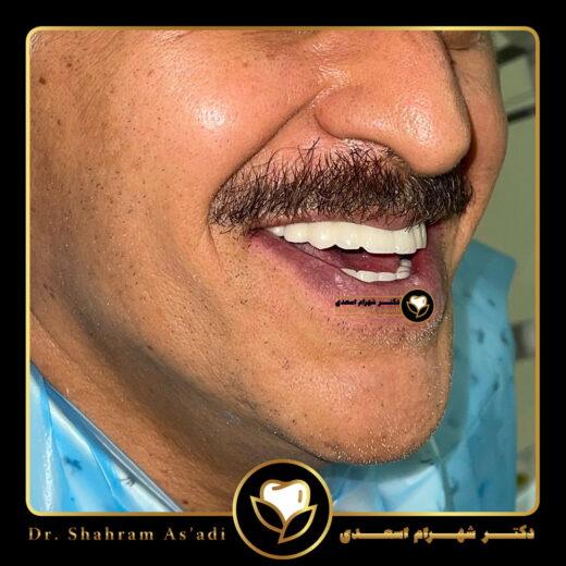 طرح لبخند هالیوودی
