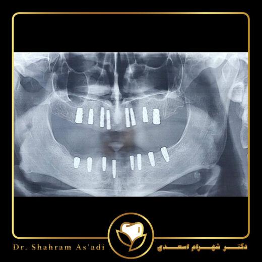 استفاده از لیزر در کاشت ایمپلنت دندان