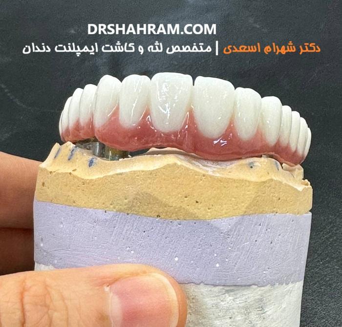 کاشت ایمپلنت پانچ
