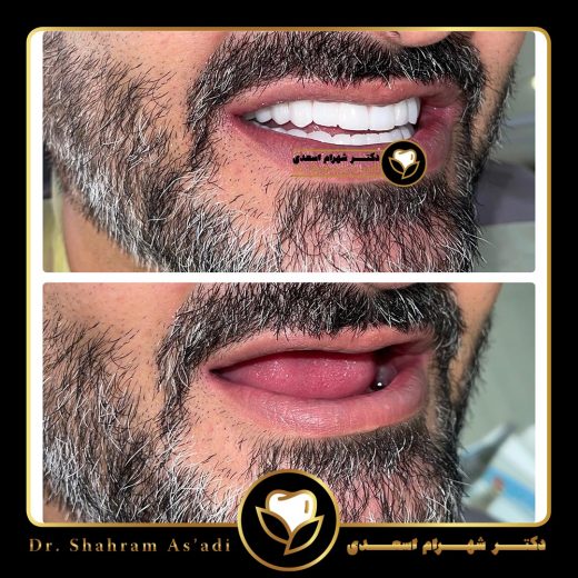 هزینه ایمپلنت دیجیتال