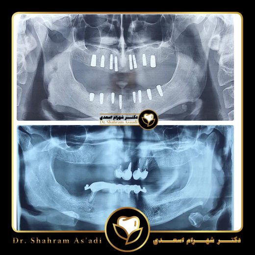 مزایای ایمپلنت دیجیتال