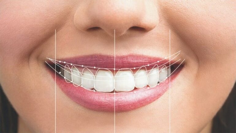 بررسی همه جانبه انواع لمینت دندان