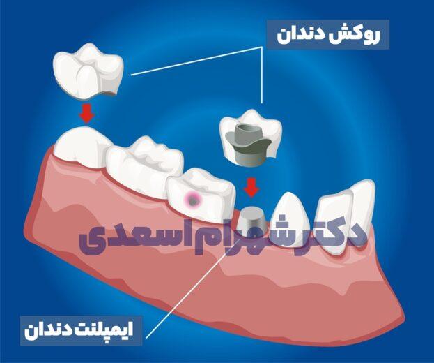 ایمپلنت بهتره یا روکش؟!