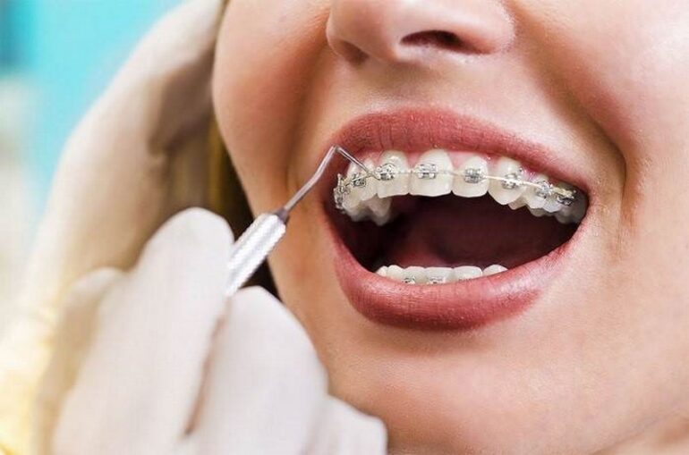 لمینت دندان یا ارتودنسی؟! کدام بهتر است؟
