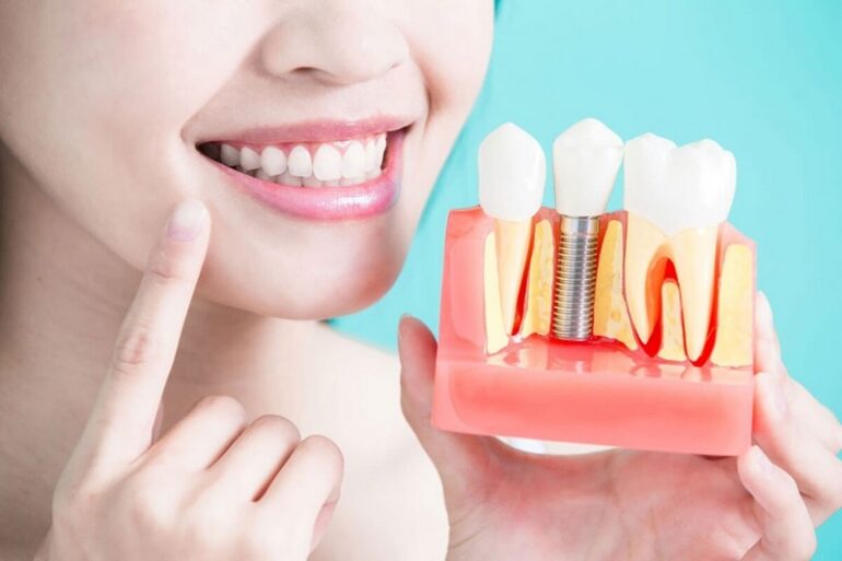 ایمپلنت بهتره یا بریج؟
