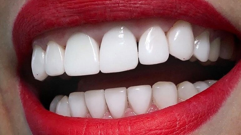 تراش دندان برای لمینت