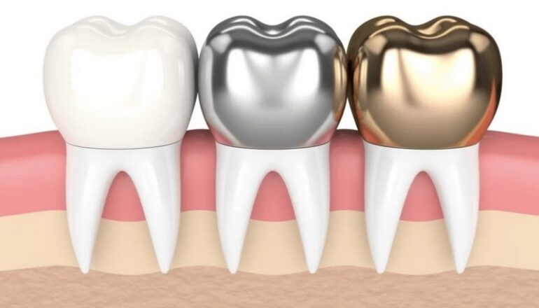 بهترین روکش برای دندان آسیاب چیست؟