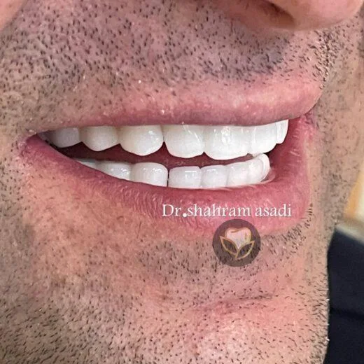 نمونه ایمپلنت دندان