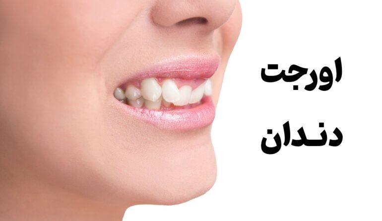 اورجت دندان چیست؟ عوامل و درمان جلوزدگی دندان