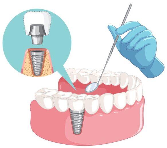 ایمپلنت دیو DIO چیست و چه مزایایی دارد؟