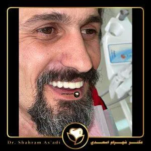 مدت زمان ایمپلنت دندان