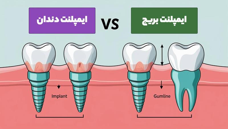 ایمپلنت دندان یا ایمپلنت بریج