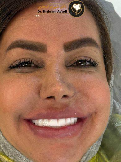 کدام مرحله ایمپلنت دندان سخت تر است؟