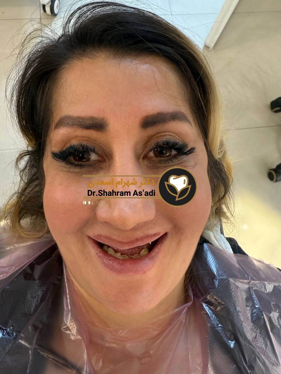 ایمپلنت برای افراد دیابتی