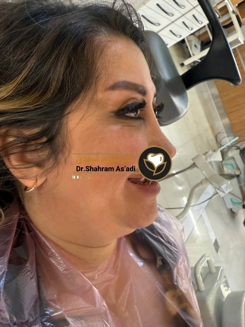 ایمپلنت و دیابت