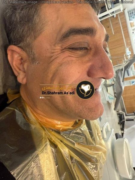نقش ایمپلنت دیجیتال در پیشگیری و کاهش عوارض شایع جراحی