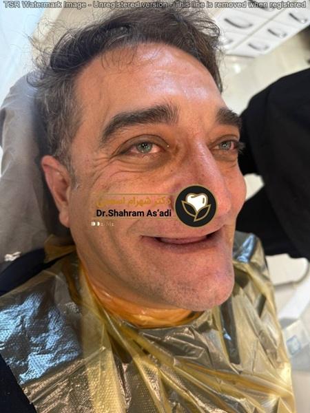 تفاوت ایمپلنت دیجیتال و سنتی