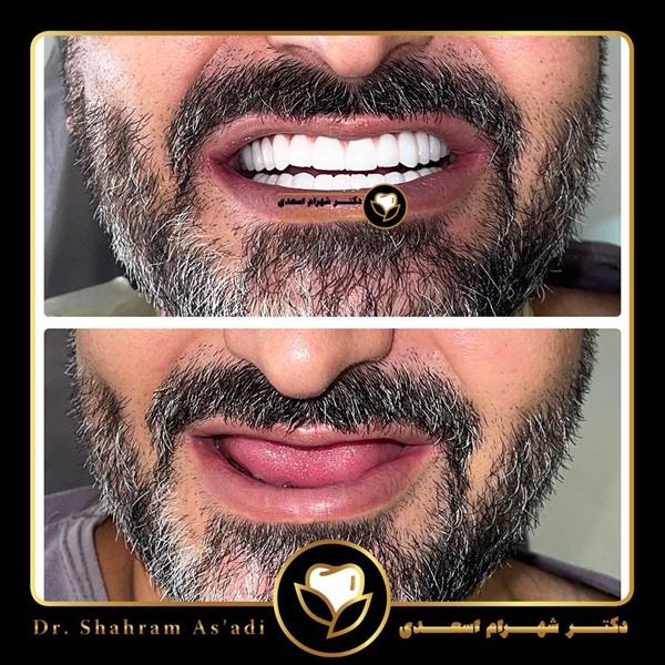 انواع ایمپلنت دیجیتال