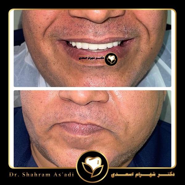 انواع ایمپلنت دیجیتال و رویکردهای نوین کاشت