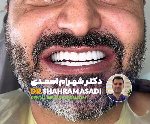 ایمپلنت فوری