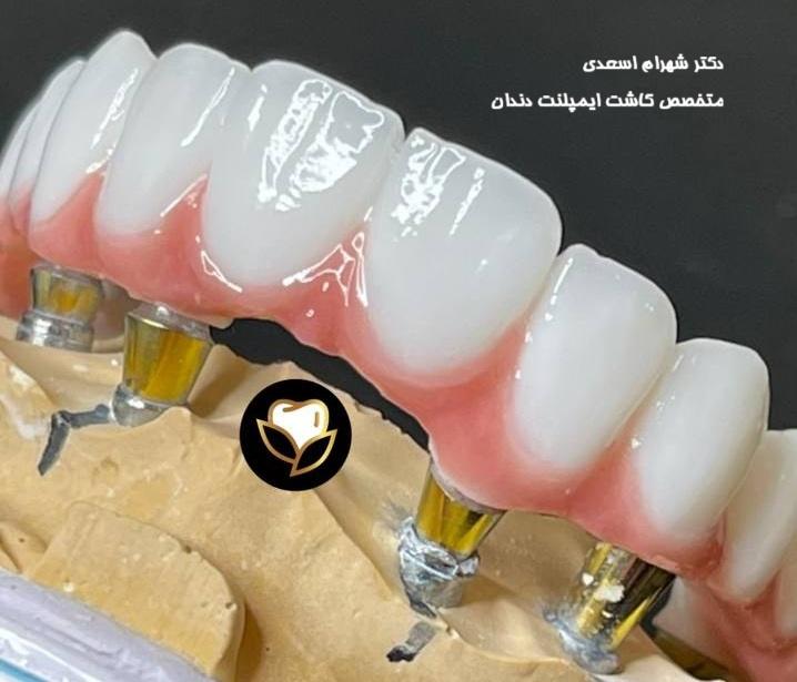 عوارض کاشت ایمپلنت دندان