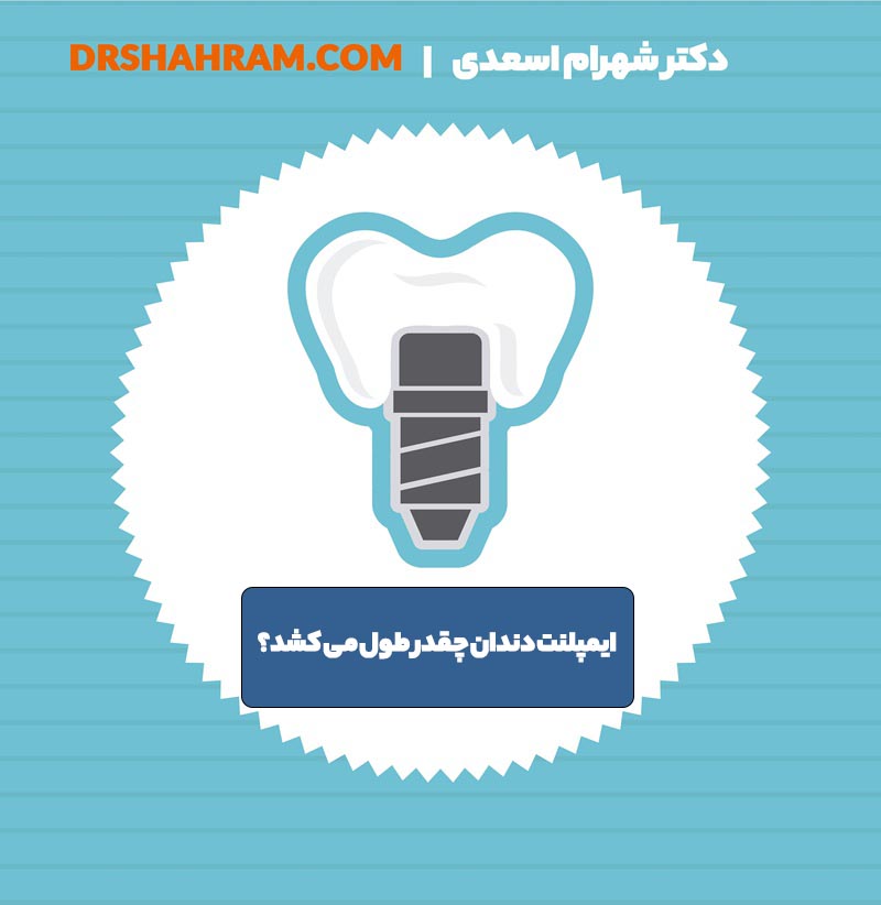 ایمپلنت دندان چقدر طول میکشد؟ راهنمای کامل مدت زمان کاشت ایمپلنت