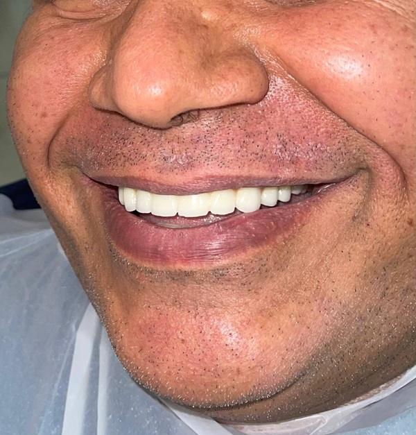 چرا ایمپلنت زیمر