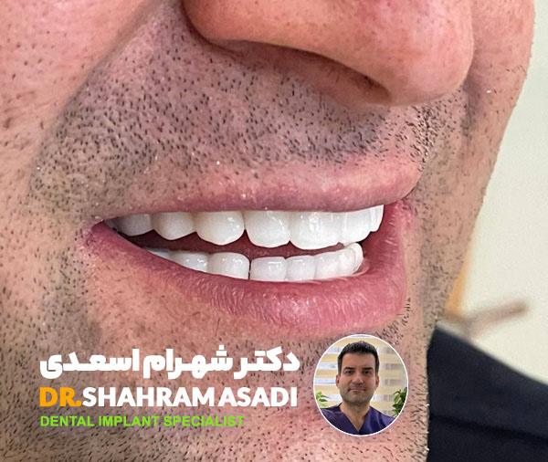 انواع ایمپلنت دندان