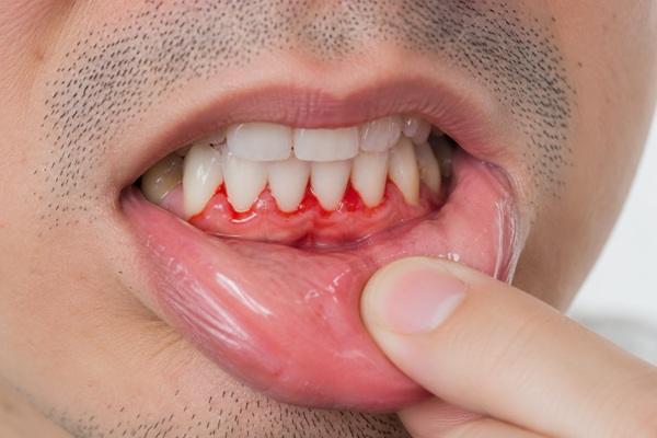خونریزی لثه؛ چه زمانی باید نگران باشیم؟
